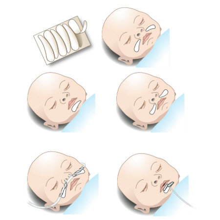 Whiskers Securement Devices