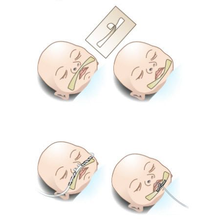 Whiskers Securement Devices